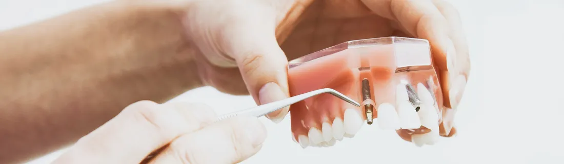 FC – Dental Implants at Dr. Leo Christensen – Tooth Carpenter in Coalville UT